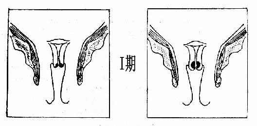(4)宫颈糜烂,裂伤与外翻 由于子宫颈的生理和解剖上的缘故,容易遭受