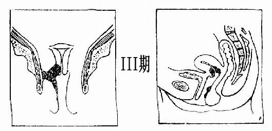 宫颈癌的知识信息汇总